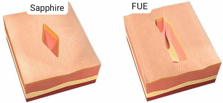 Hair transplant result 2