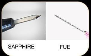 Hair transplant result 1