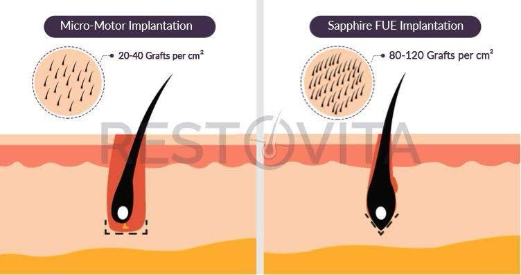 Hair transplant result 4