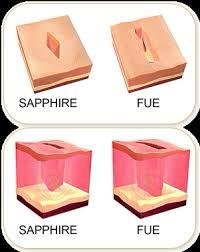 Hair transplant result 3
