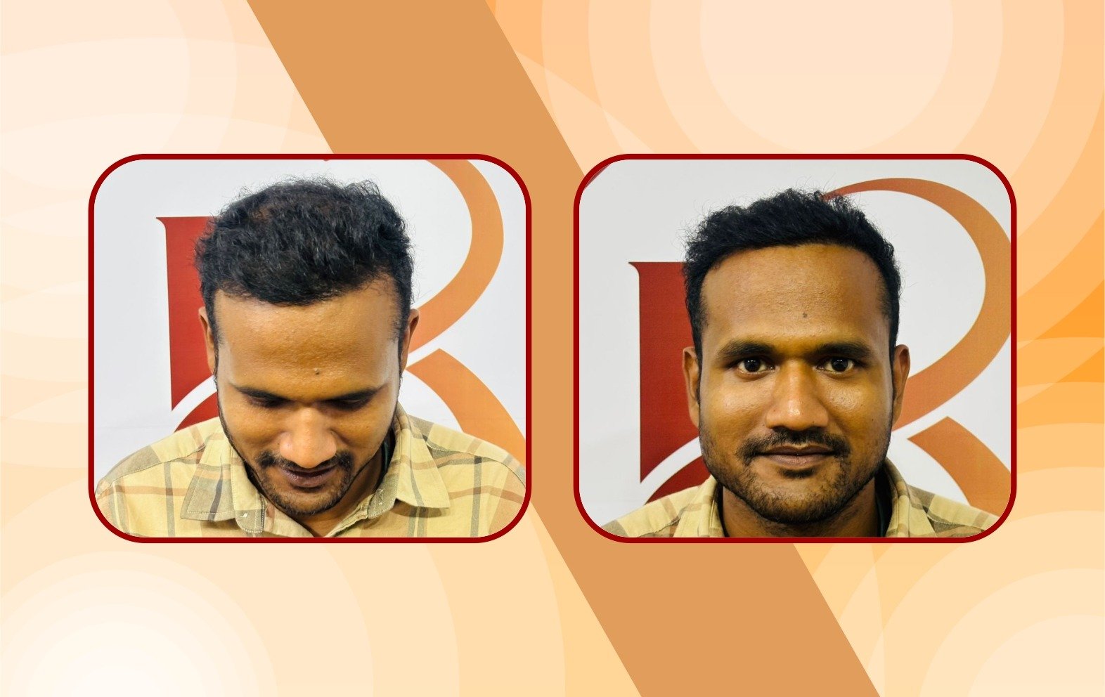 Before – scar visible