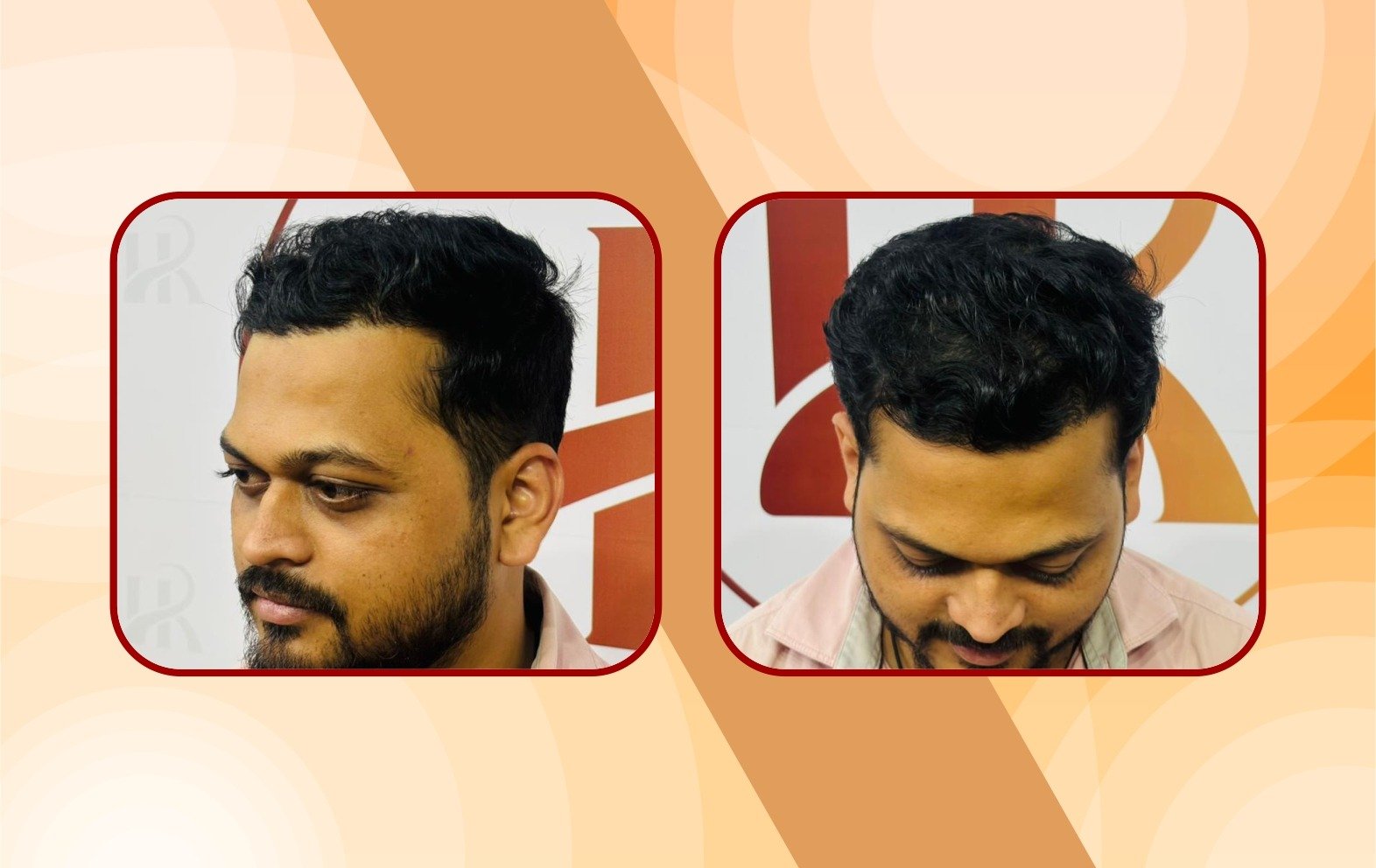 Before – crown thinning