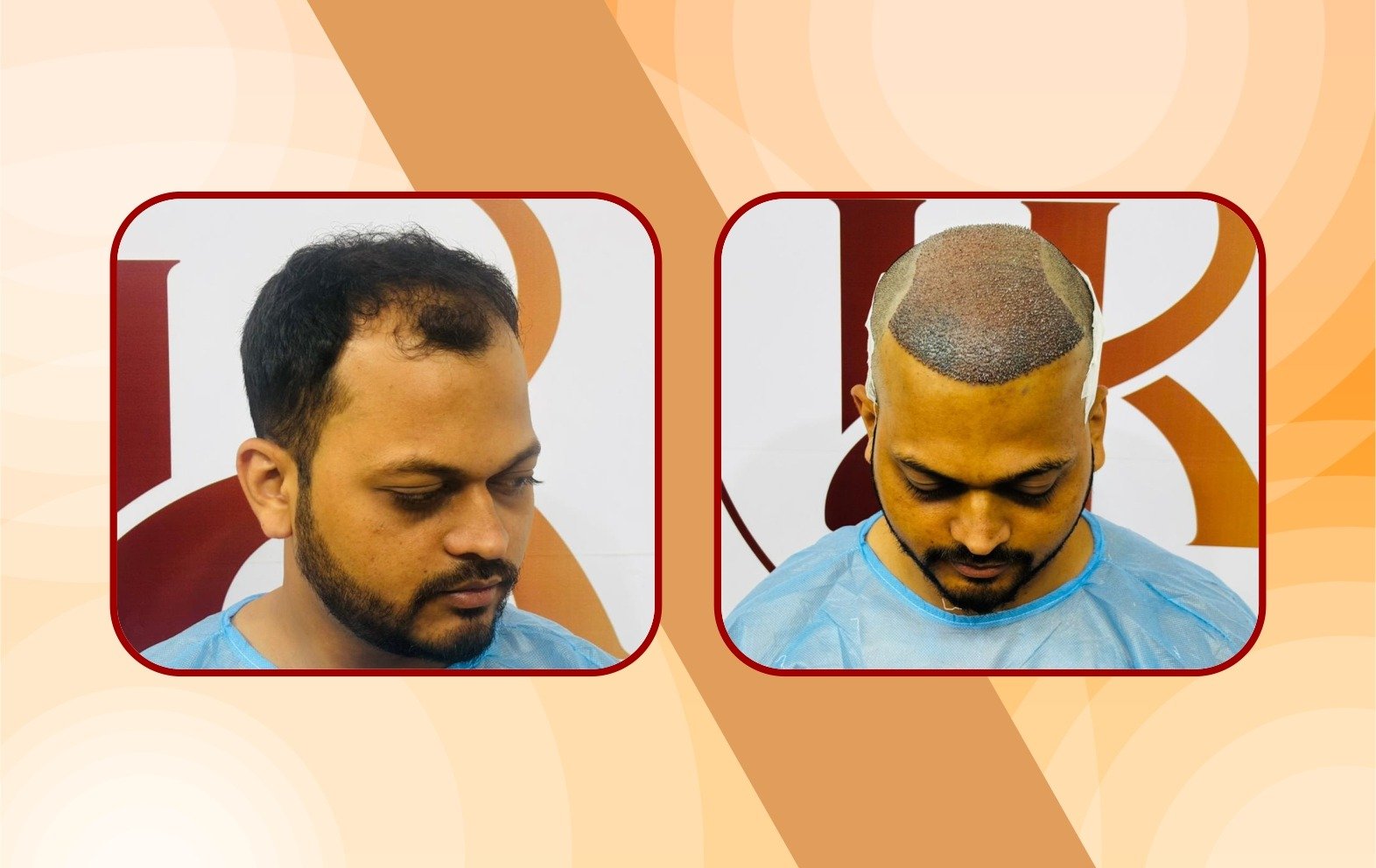 After – crown density improved