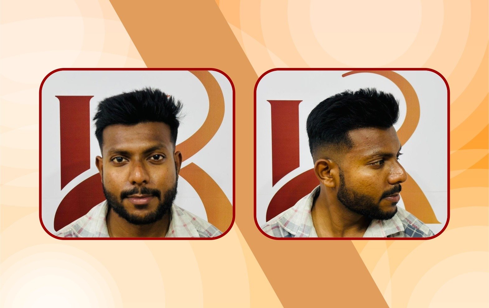 Before – frontal hairline