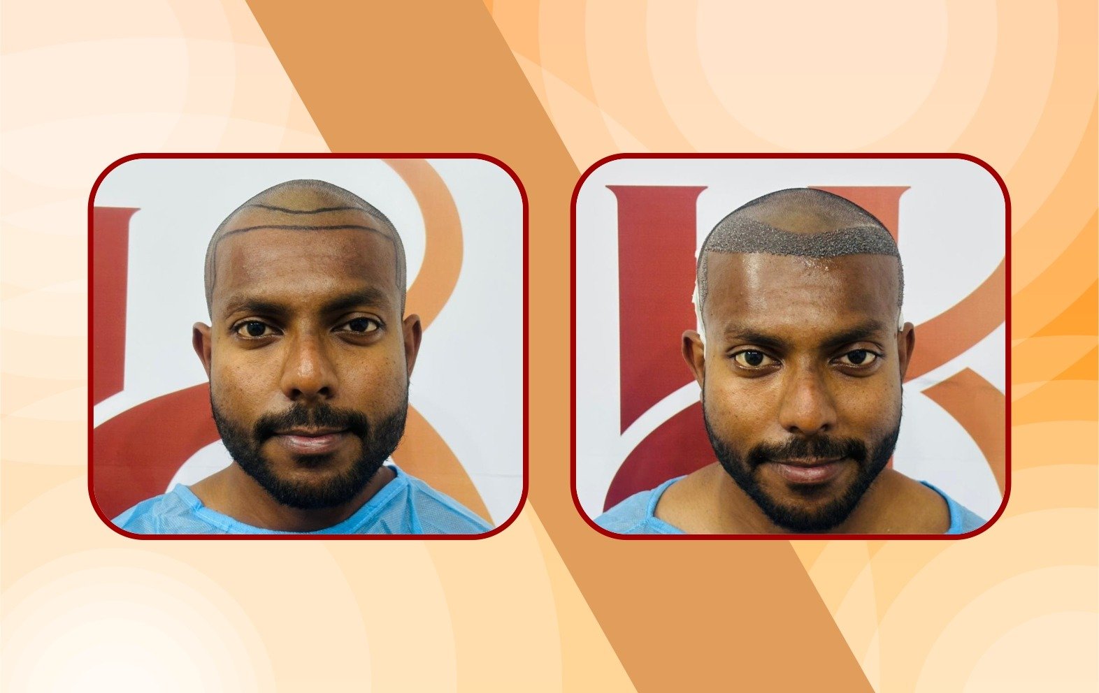 After – frontal hairline restored